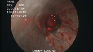 Микрогайморотомия удаление кисты верхнечелюстной пазухи 18112015