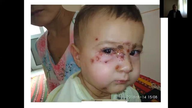 Пиодермиялар смотреть онлайн