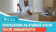 ? Покраснение и эрозия на крайней плоти после пимафукорта.  Клинический случай №749