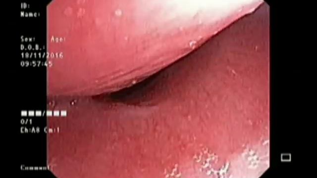 Sec Laryngotracheomalacia