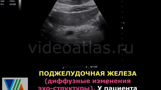 Диффузные изменения поджелудочной железы при сахарном диабете смотреть онлайн