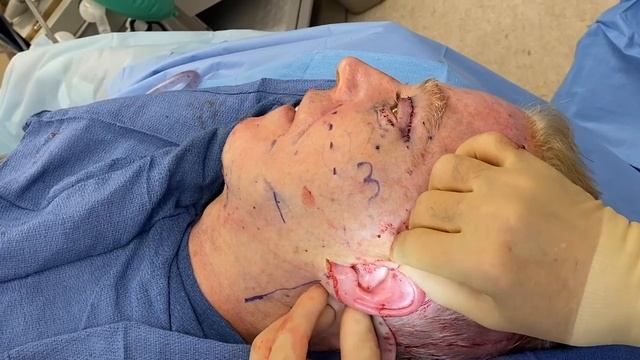 UNBOTCHED Ep. 20: Finesse in Male Face Lifting with Dr. Rohrich смотреть онлайн