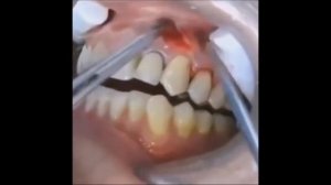 гной в десне