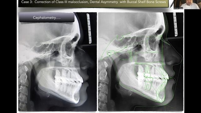 [LECTURE :12] Challenges In Treatment With Buccal Shelf Screws (BSS) | Orthodontic Bone Screws (OBS