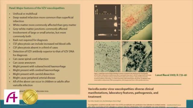 Herpes Zoster: severe cases and latest updates on prevention. A talk on 20 Jan 2022 at TWAH, HK смотреть онлайн