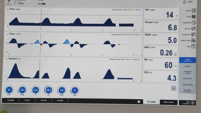 Module 3: Respiratory System and mechanical ventilation - Part 2 смотреть онлайн
