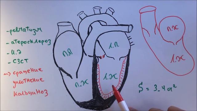 Стеноз устья аорты (аортальный стеноз)