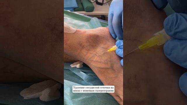 Удаление сосудистого рисунка на ногах. #склеротерапия #флебологкраснодар #сосудистыйхирургкраснодар смотреть онлайн