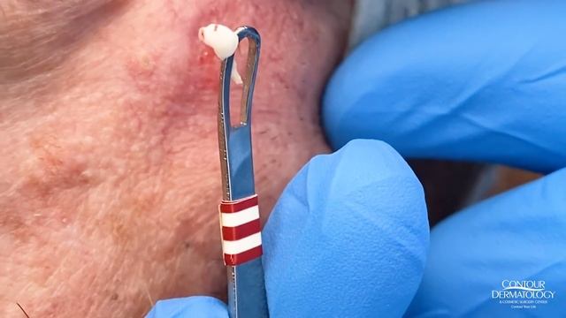 Best Pimple Popping Videos Of 2020 + Unseen Blackhead And Cyst Videos | CONTOUR DERMATOLOGY