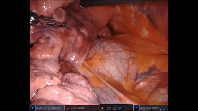 Robotic-Assisted Right Upper Lobectomy and Mediastinal Lymph Node Dissection смотреть онлайн