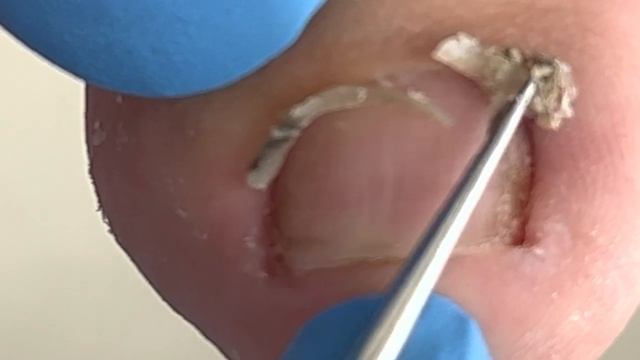 Visible black marks under the toenails!【Xue Yidao Pedicure】 смотреть онлайн