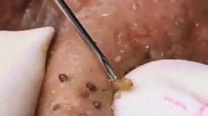 очистка лица от чёрных точек