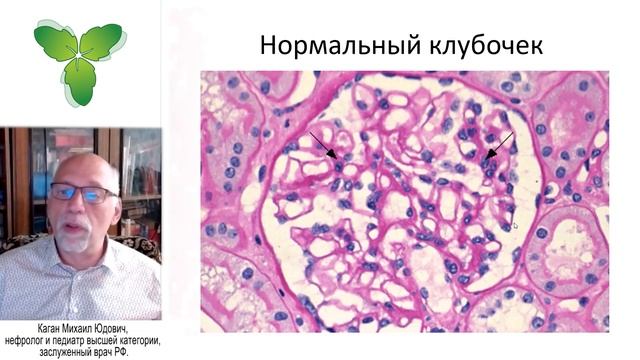 Острый постстрептококковый гломерулонефрит у детей (ОПГН) смотреть онлайн