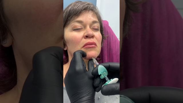 Увеличение подбородка филлерами и коррекция подбородочной морщины. смотреть онлайн