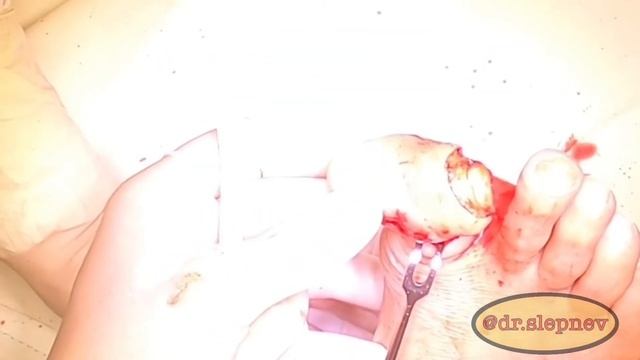 Ампутация 1 пальца стопы на уровне основной фаланги. смотреть онлайн