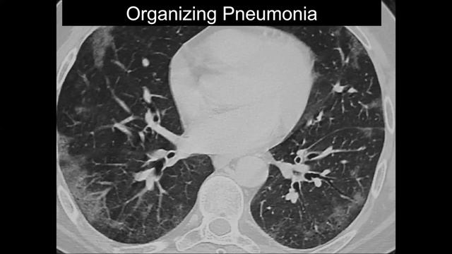 CT Patterns of Lung Disease, Dr. Jannette Collins - MRI Online Noon Conference смотреть онлайн