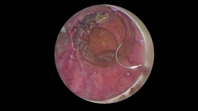 Ушивание дефекта прямой кишки после удаления полипа. смотреть онлайн