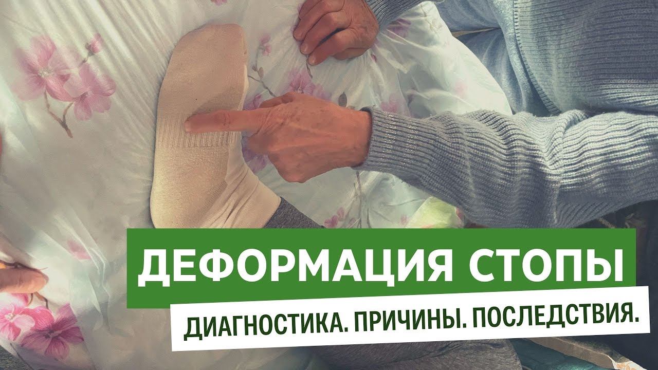Деформация стопы. Диагностика. Причины. Семинар Н.Л.Лоскутовой смотреть онлайн