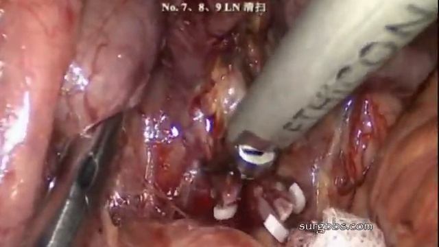 Laparoscopic D2 lymph node dissection for gastric cancer смотреть онлайн