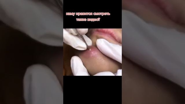 Самое залипательное видео давить прыщи Черные точки