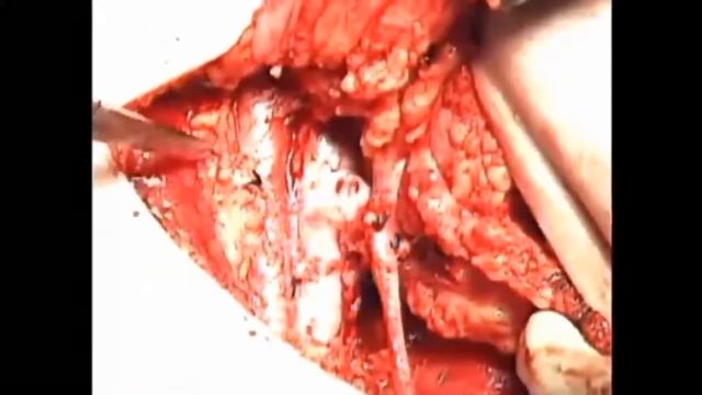 Inguinofemoral Lymphadenectomy Surgery |Step by Step Procedure | смотреть онлайн