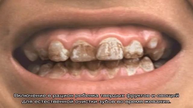 Коричневый налет на зубах у ребенка
