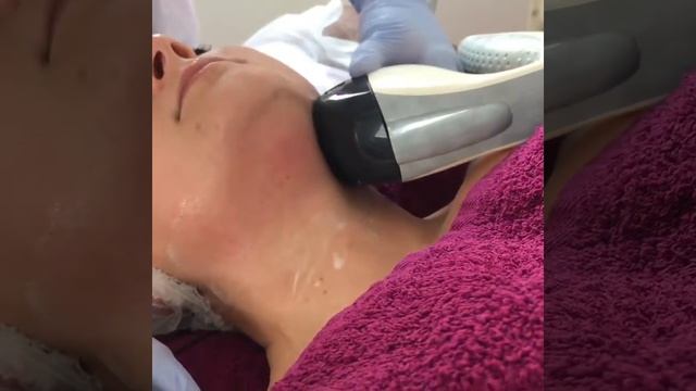 Velashape 3. Подбородок. Клиника Хиневича в Минске