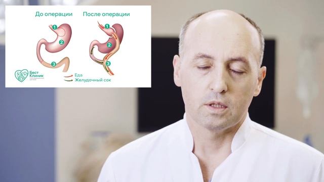 Коррекция избыточного веса. Гастропластика. смотреть онлайн