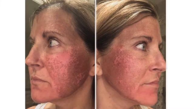 Dr. Behr's Fraxel Treatmment смотреть онлайн