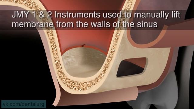 Техника синус лифтинга смотреть онлайн