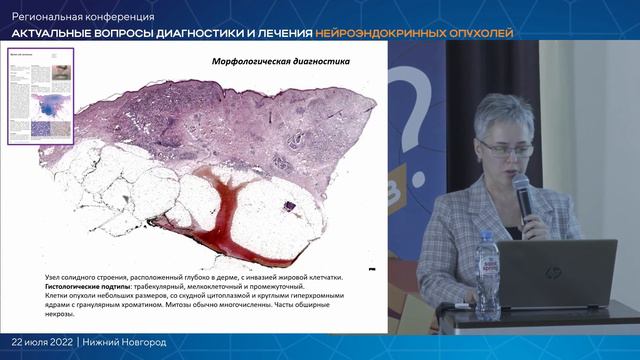 Морфологическая диагностика карциномы Меркеля. Демонстрация клинического случая // Давыдова Д.А. смотреть онлайн