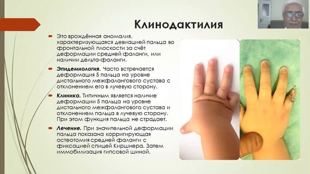 Врожденные аномалии развития верхней и нижней конечности смотреть онлайн