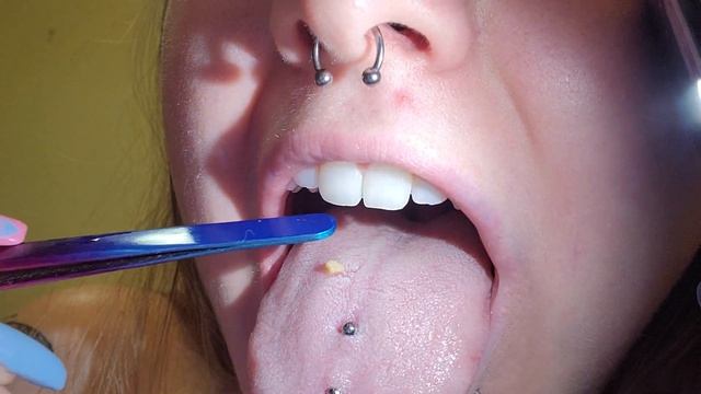 Tonsil stone removal, home removal, raw audio смотреть онлайн
