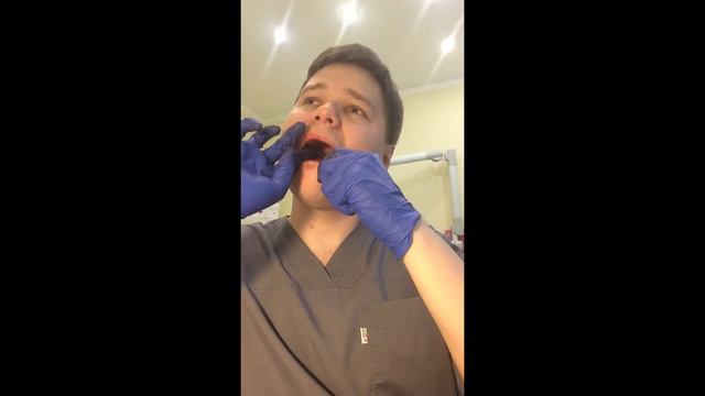 Self-extraction of an upper right wisdom tooth\Удаление верхнего зуба мудрости(восьмерки) смотреть онлайн