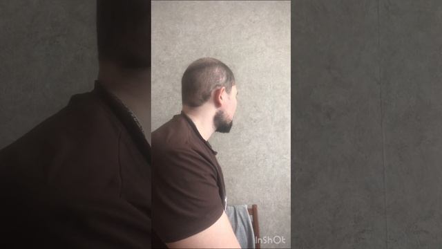 35 Дней по трансплантации волос в Турции #обзорволос #пересадка #результатпересадкиволос смотреть онлайн