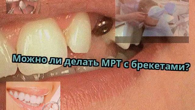 Можно ли делать МРТ с брекетами? Канал Dento Video смотреть онлайн