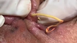 ✅ Выдавливание прыщей #7