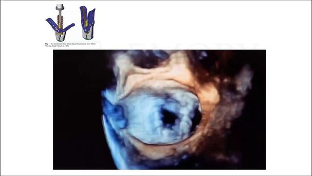 Anatomy of a Murmur смотреть онлайн