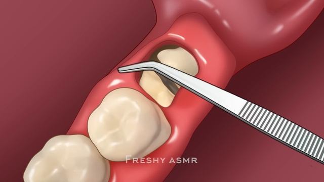 ASMR Impacted wisdom tooth extraction removal | Dental care animation смотреть онлайн