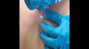 Удаление образования на коже при помощи лазера