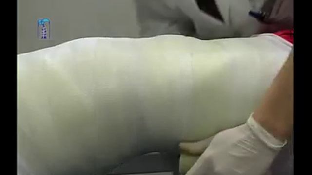 Método de reducción e inmovilización de fracturas toraco-lumbares en cama de hiper-extensión смотреть онлайн