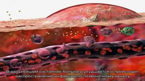 Что такое сакроилеит