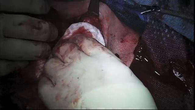 Thyroid Surgery & Its Risks / Complications (Thyroidectomy) (GRAPHIC) смотреть онлайн
