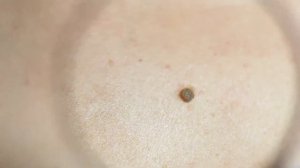 10 признаков для распознавания опасной родинки (НЕВУС), способной превратиться в рак