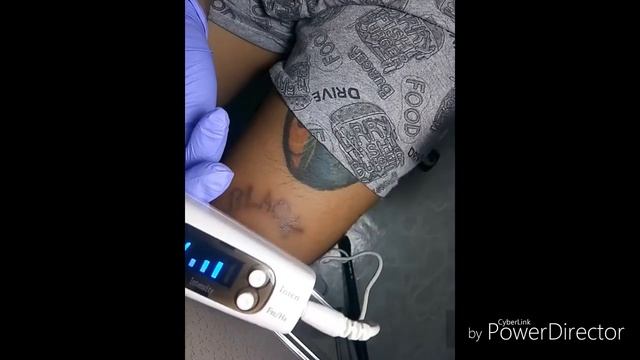 (NEATCELL) 3rd session picosecond laser pen tattoo removal смотреть онлайн