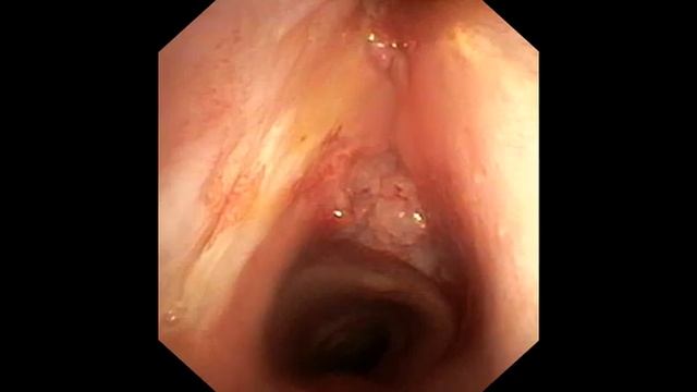 Диагностика рака гортани методом ультразвуковой эндосонографии смотреть онлайн