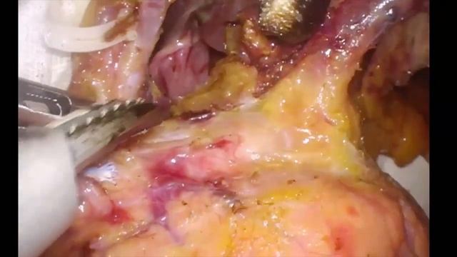 Laparoscopic D2 Distal Gastrectomy
