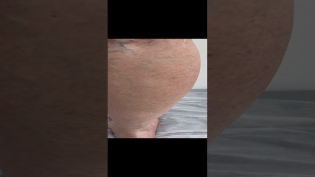 Готовимся к проведению склеротерапии. Флеболог Москва. Сосудистый хирург. Флеболог смотреть онлайн