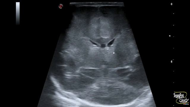 Neonatal Cerebral Edema || Ultrasound || Case 278