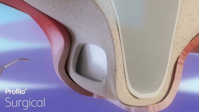 Dental Implants | Sinus Lift & Bone Graft